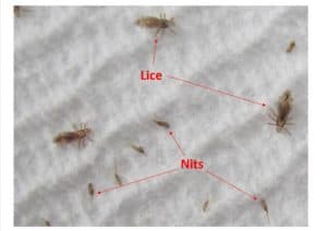 head lice diagram showing lice terminology